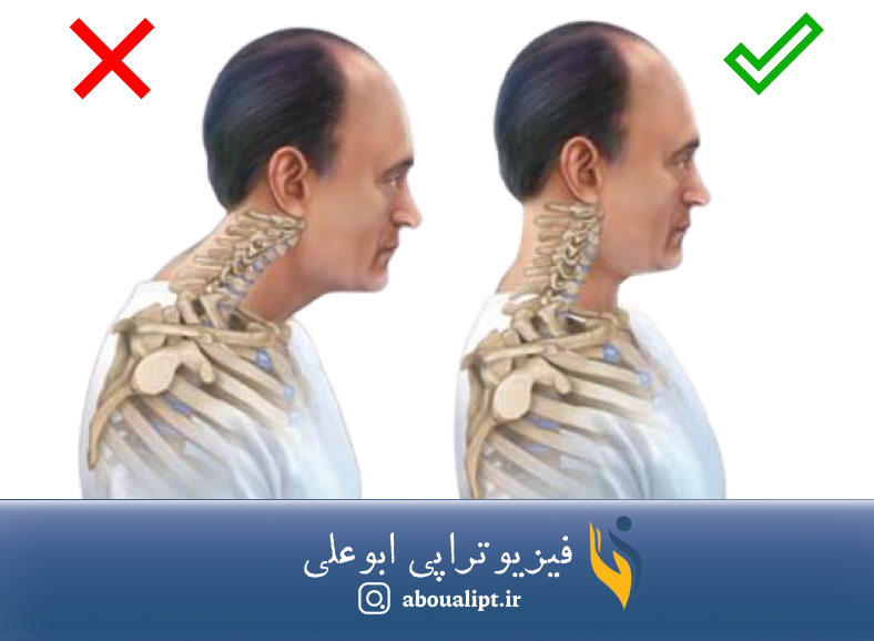 در تصویر وضعیت و پاسچر صحیح گردن و هم‌چنین وضعیت و پاسچر نامناسب گردن نشان داده شده است.
