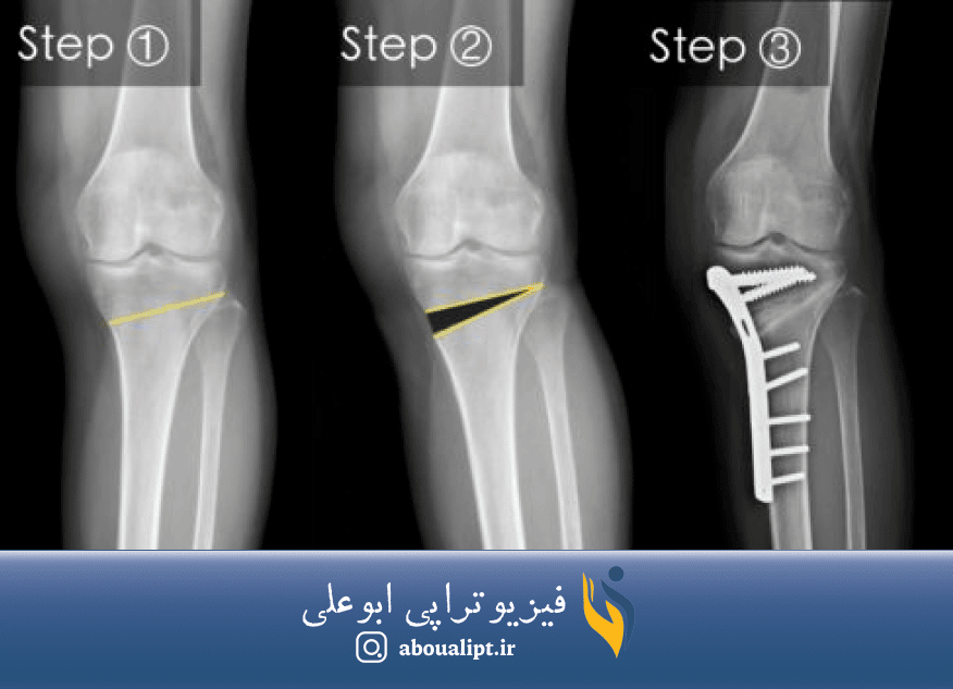 در تصویر جراحی استئوتومی زانو در سه مرحله نمایش داده شده است.