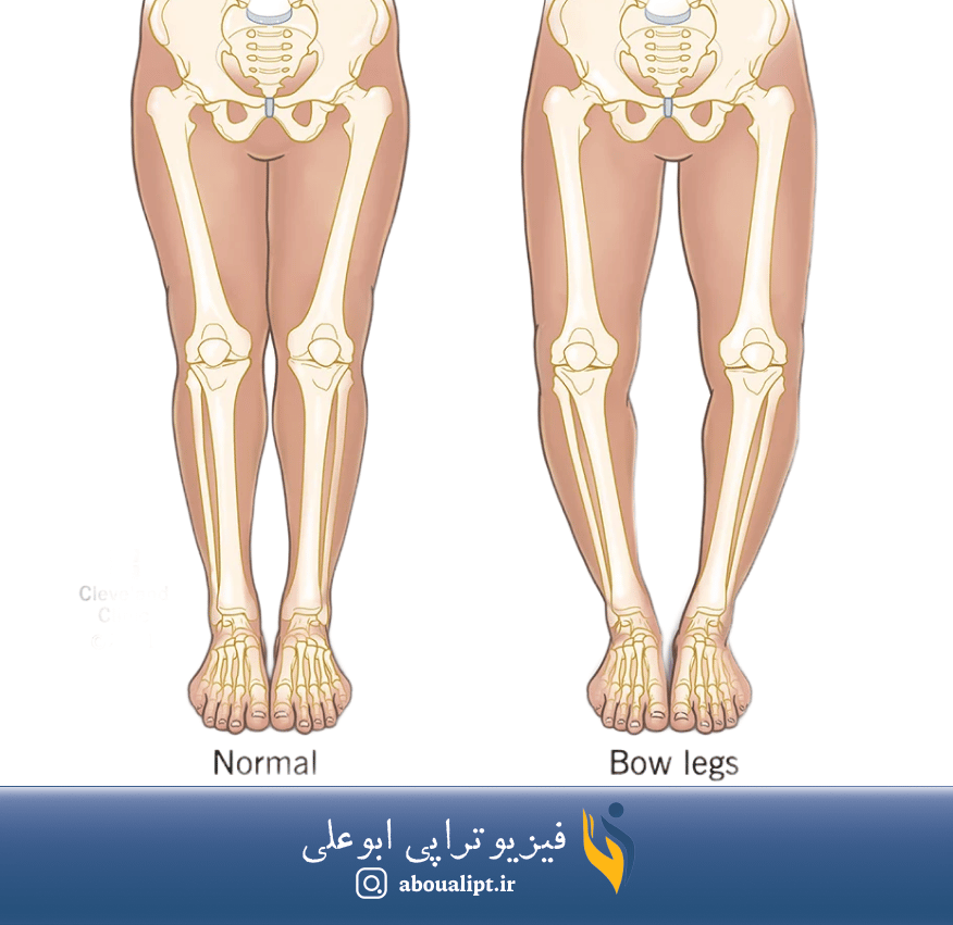 در تصوير استخوان‌بندی زانو و پا در حالت طبيعي و سالم و در حالت زانو و پای پرانتزی نمایش داده شده است. 