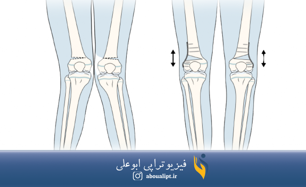 در تصوير، استخوان بندی زانوی ضربدری قبل و بعد از جراحی استئوتومی نشان داده شده است.