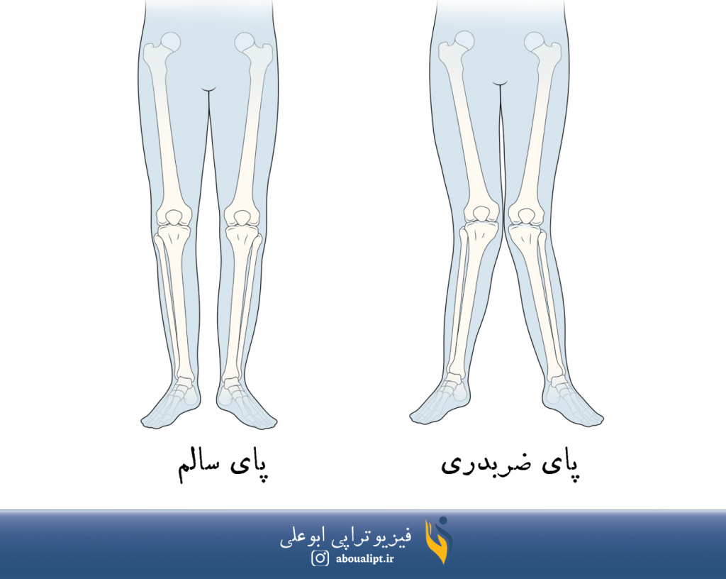 در تصویر، پا در حالت سالم و زانو در حالت ضربدری نمایش داده شده است.